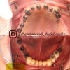 پروتز دندانی